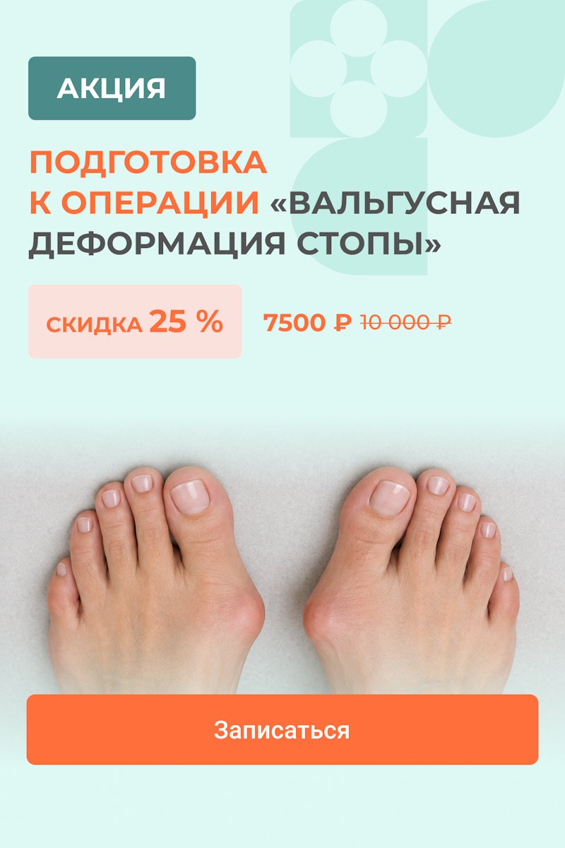 Вальгусная деформация стопы (Изображением)
