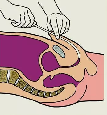 Катетеризация мочевого